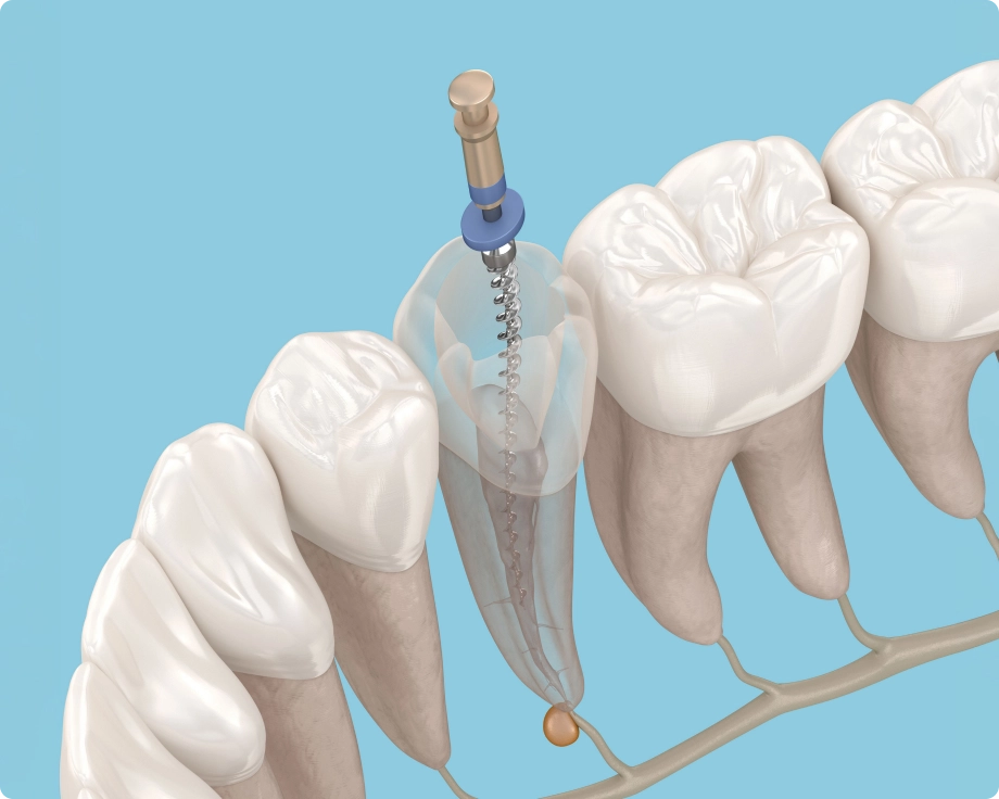 Root canal illustration