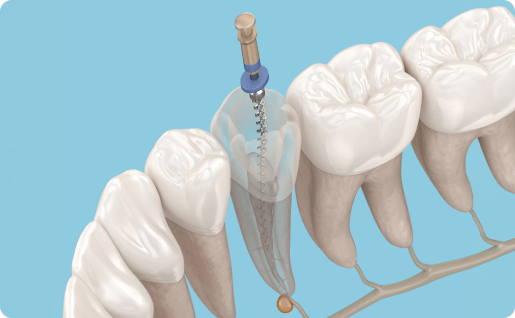 Root canal