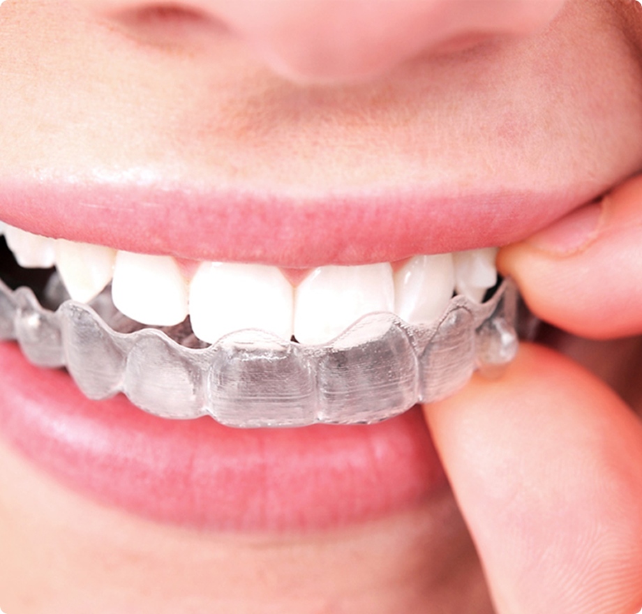 Mouthguard dental clinic