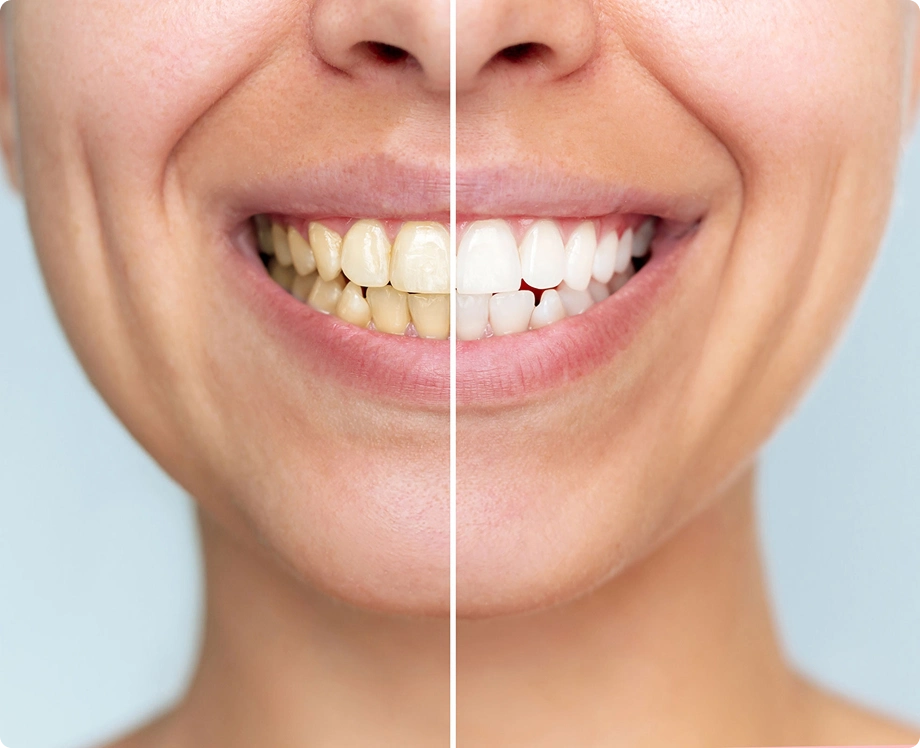 Woman smiling white teeth